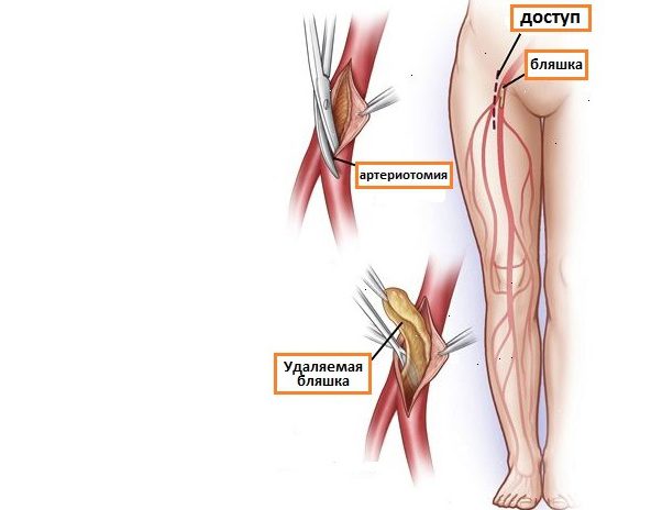 Артерия ноги операция. Эндартерэктомия нижних конечностей. Шунт артерии нижних конечностей. Атеросклероз нижних конечностей.